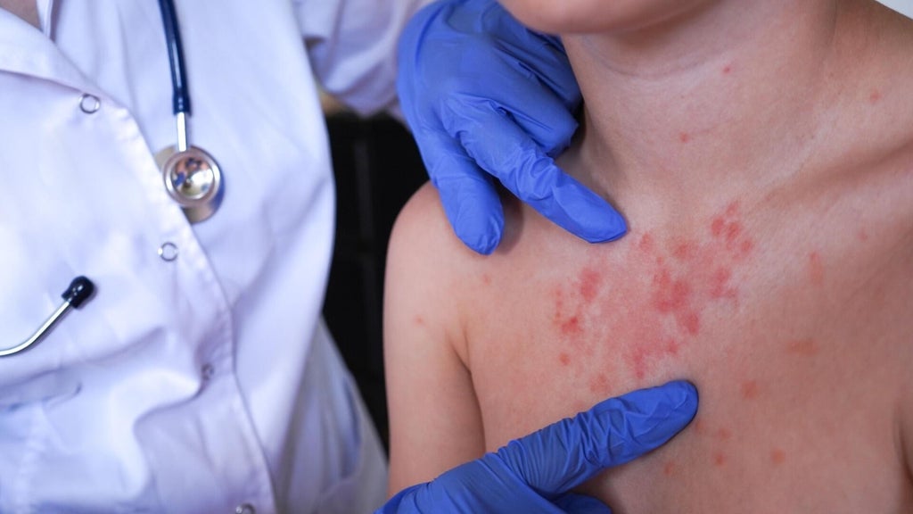 Minnesota's 80 measles cases this year are the most since 1990, health officials say — Golden Valley Health news